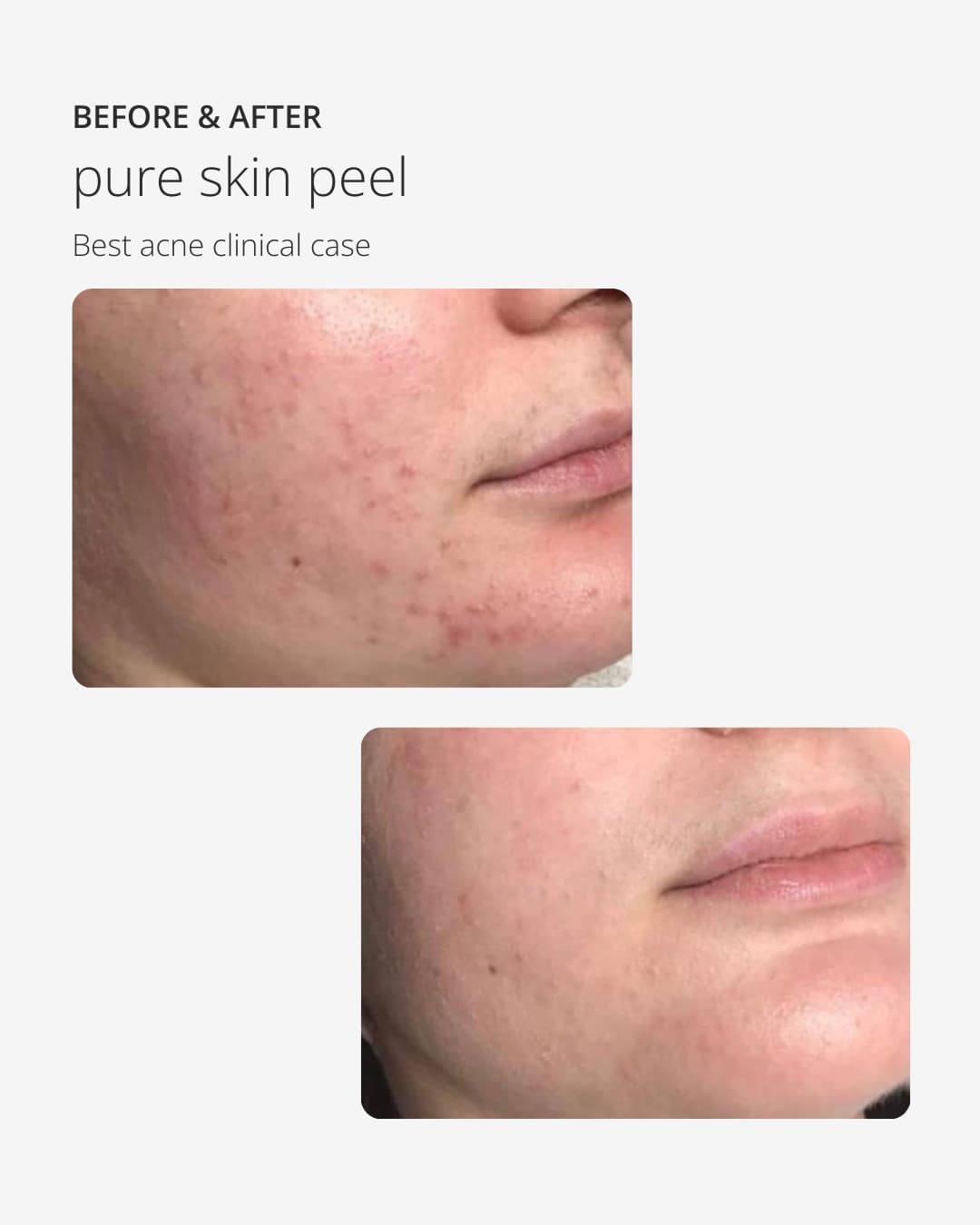 Pure Skin Peel zur Behandlung von Akne, fettiger, öliger und unreiner Haut ekseption 70ml