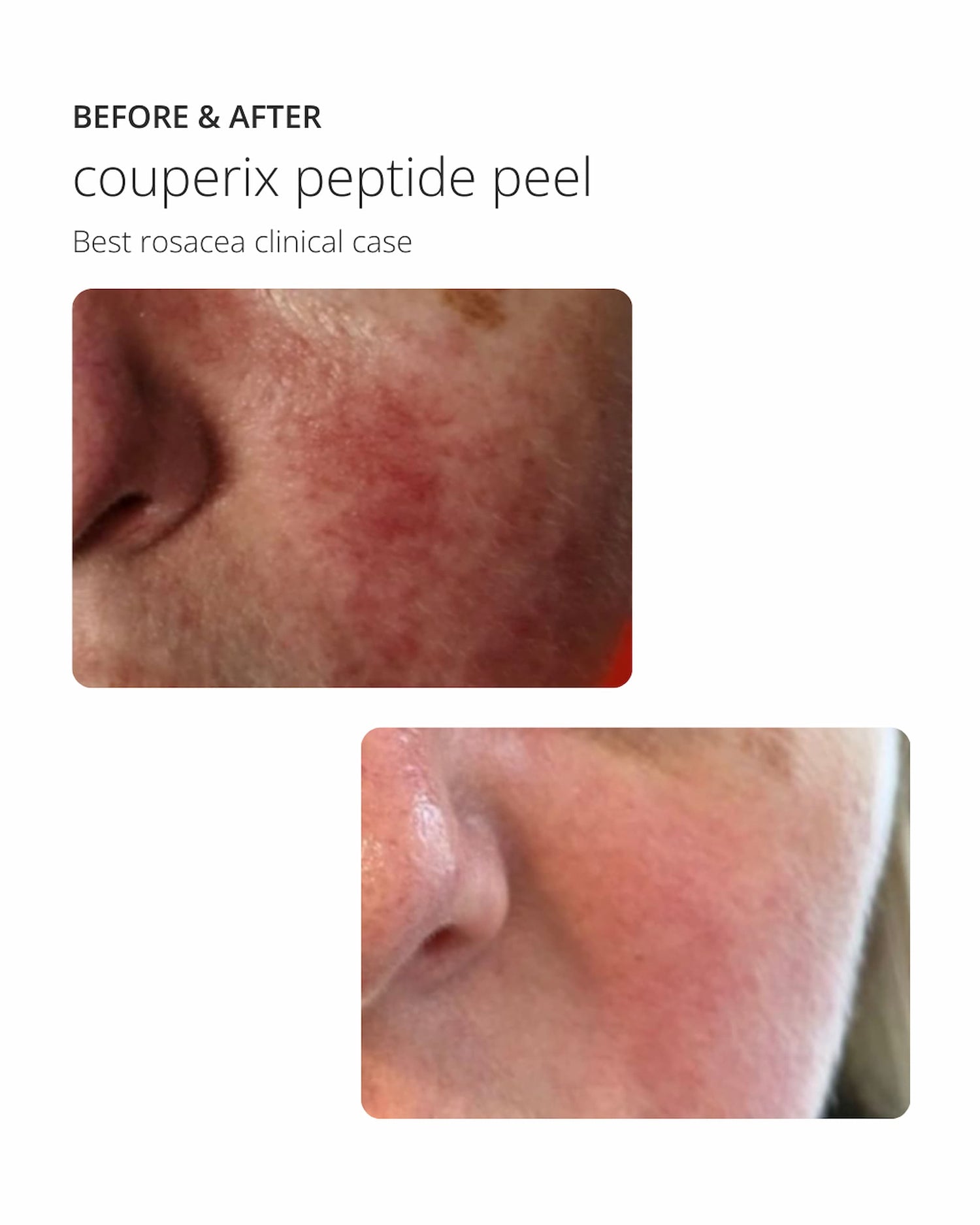Couperix peptide Peel, Oberflächliches Peeling zur Behandlung von Couperose und Hautrötungen ekseption 70ml