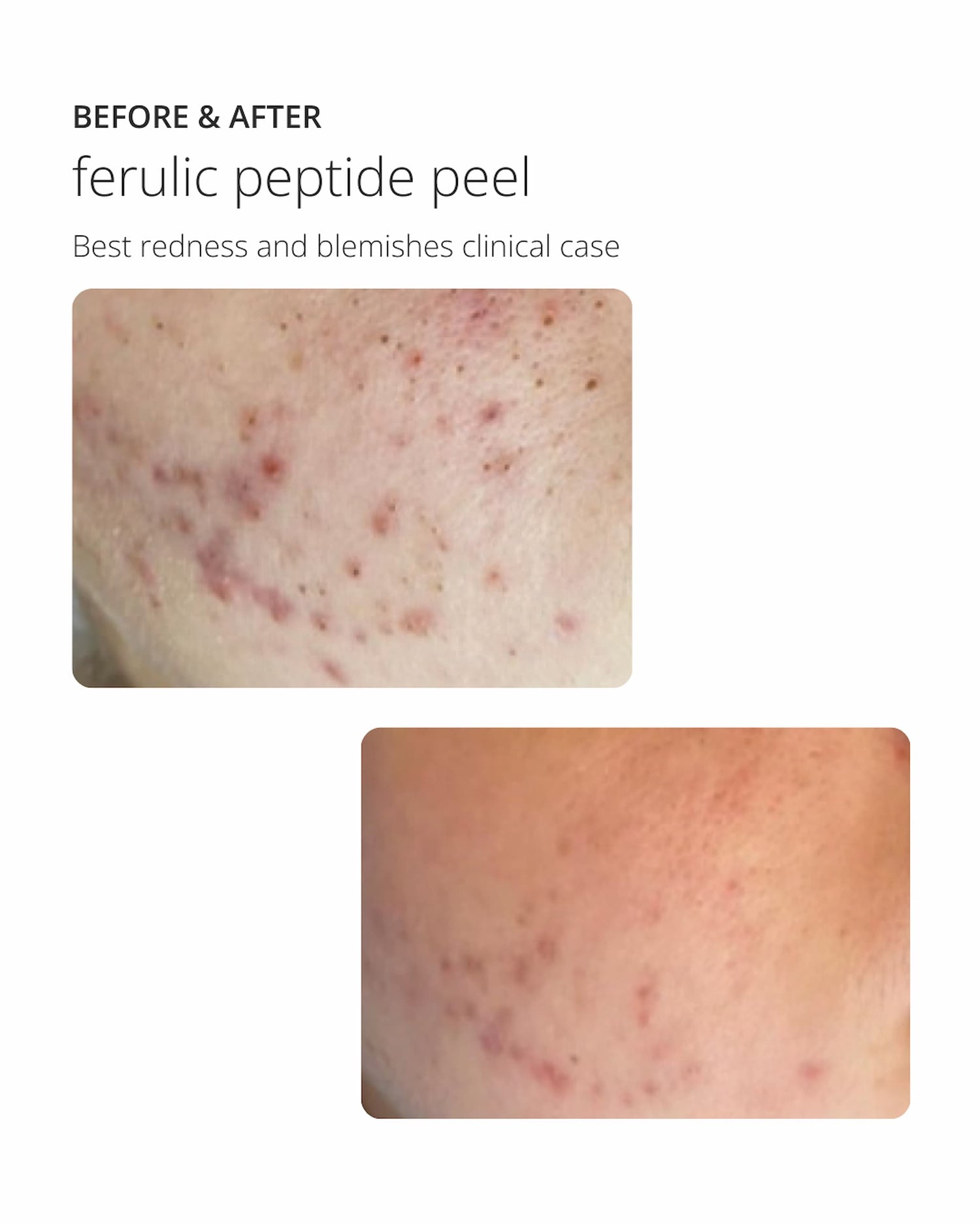 Ferulic Peptide Peel Oberflächliches Peeling zur Behandlung der globalen Hautalterung ekseption 70ml