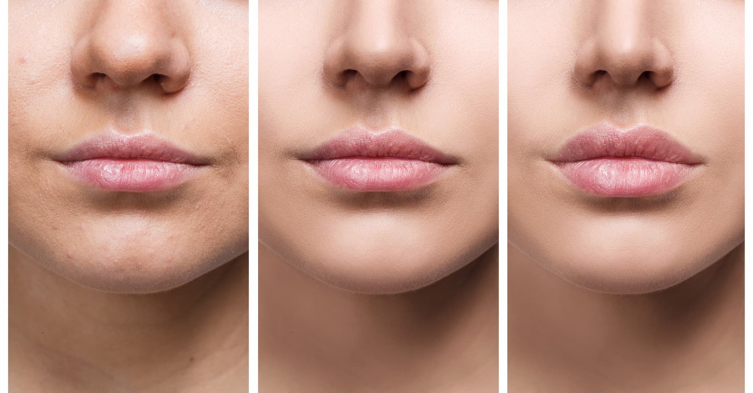F-Perfect Lips hochreine Wirkstoffe in sterilen Vials für definierte, voluminöse und farbintensivere Lippen Fusion Meso 5 x 5ml