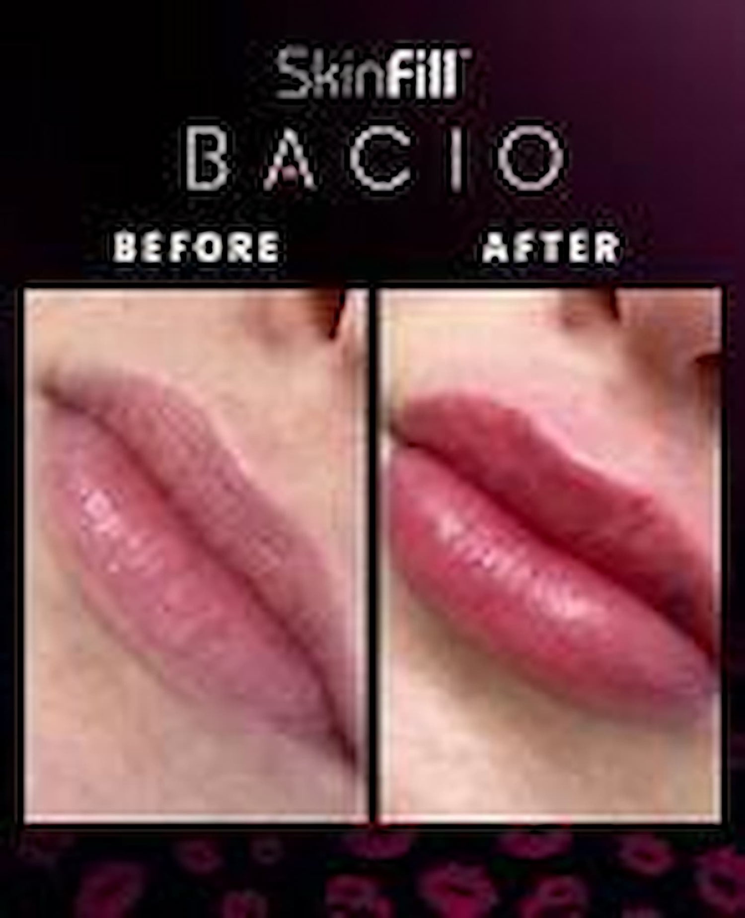 Skinfill Bacio Promoitalia Lippenbooster mit Vitamin B12