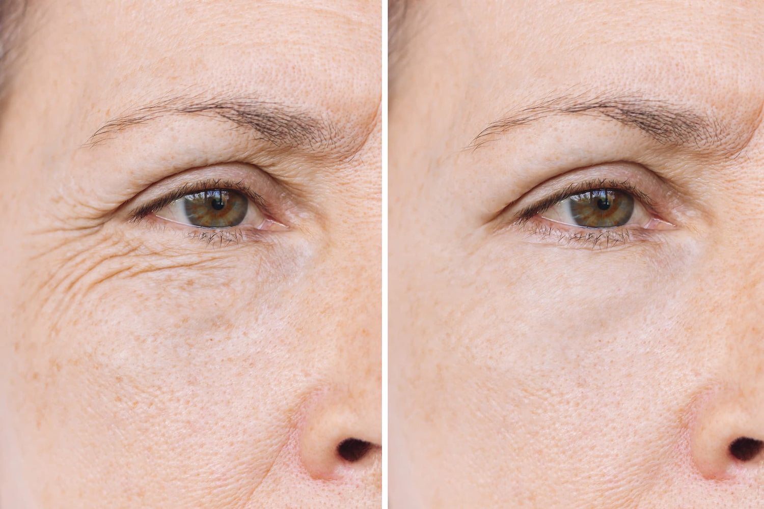 F-Eye Contour hochreine Wirkstoffe in sterilen Vials umfassende Lösung gegen Tränensäcke, dunkle Augenringe und Fältchen Fusion Meso 5 x 5ml