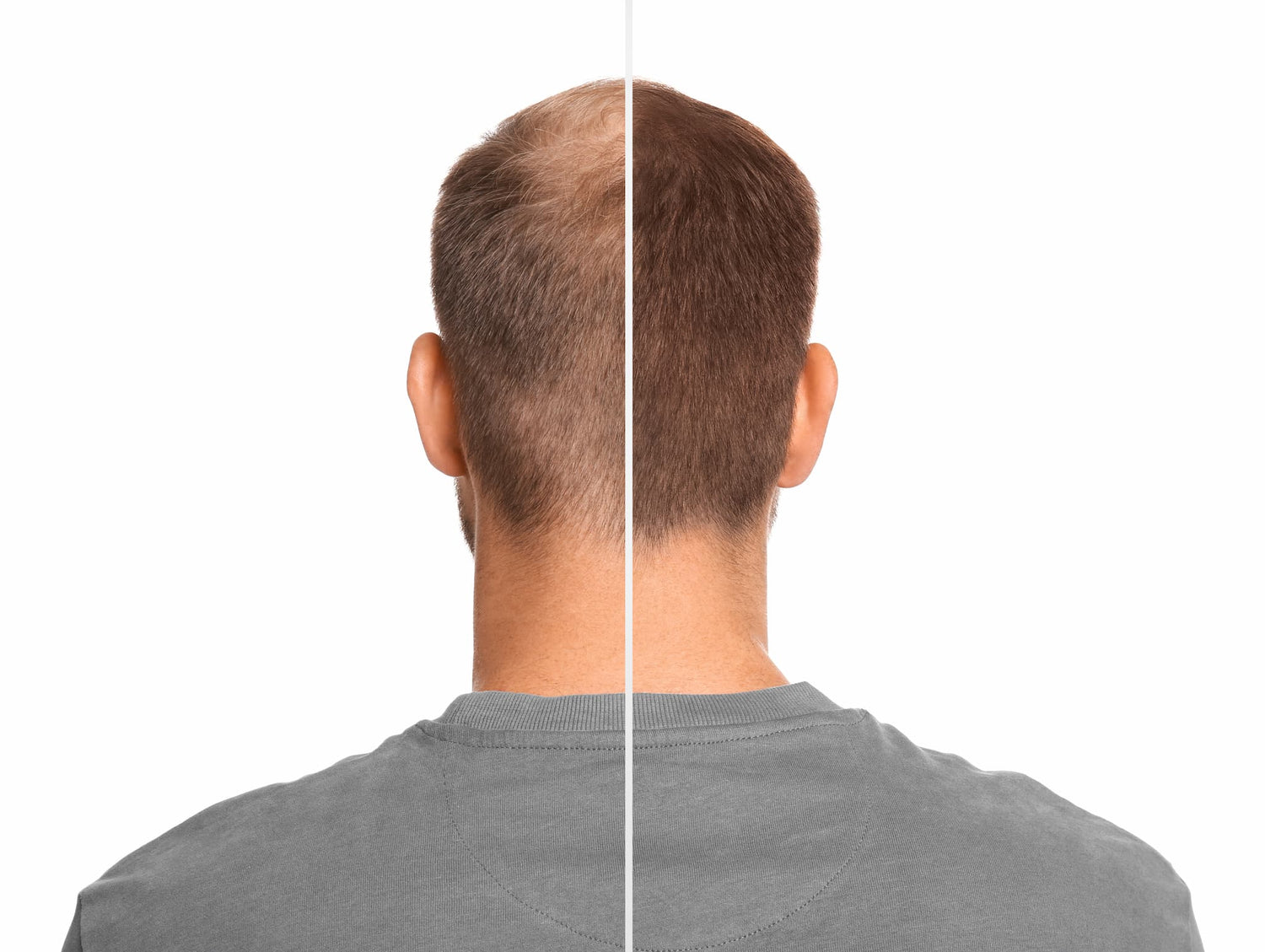 F-Hair MEN hochreine Wirkstoffe in sterilen Vials effektive Behandlung bei Alopezie und Haarausfall Fusion Meso 5 x5ml