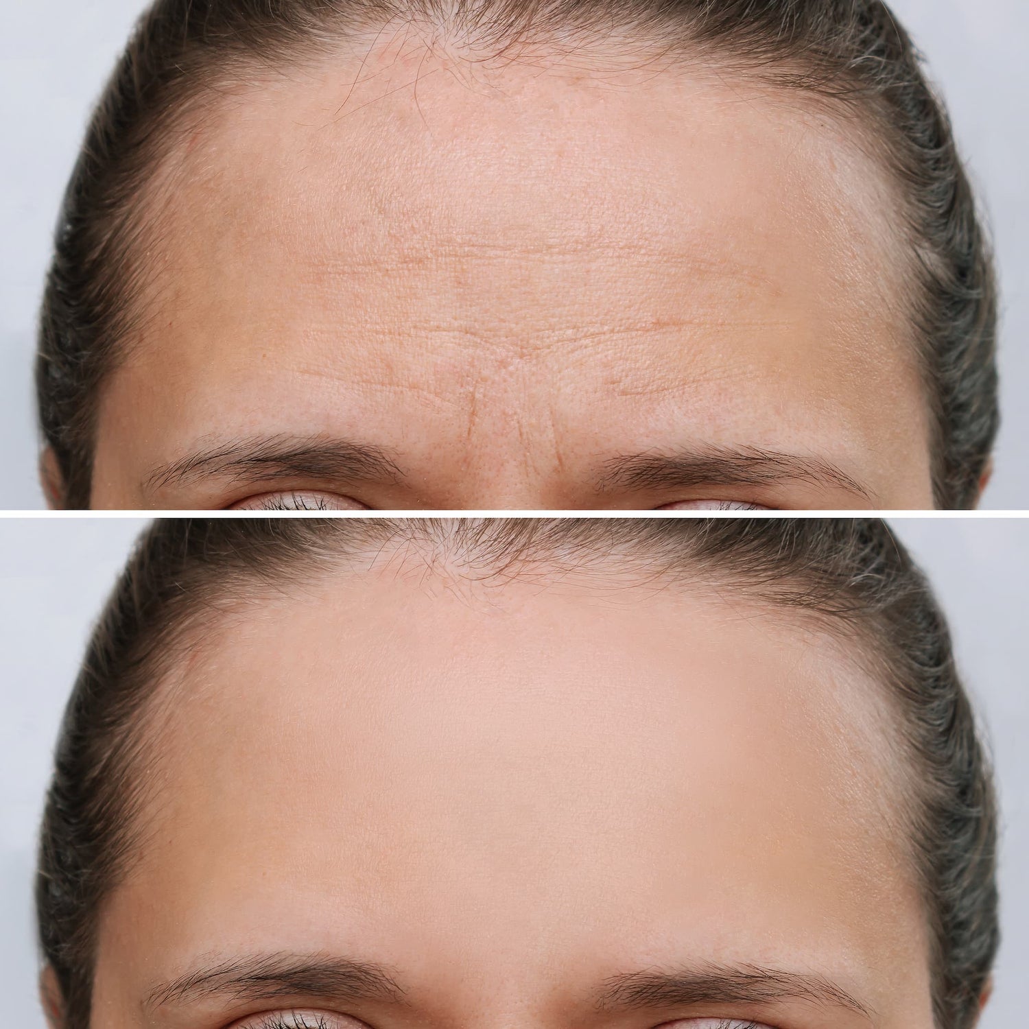 F-BTX hochreine Wirkstoffe in sterilen Vials Ergänzung zu Botolinumtoxin Fusion Meso 5 x 10ml